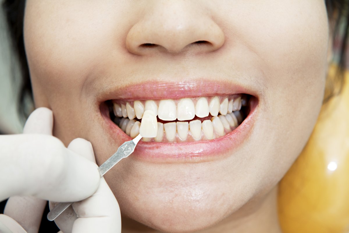 Белые пятна на зубах: как их удалить?