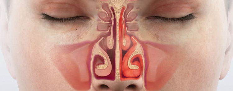 Почувствуйте облегчение: эффективные методы лечения ринита