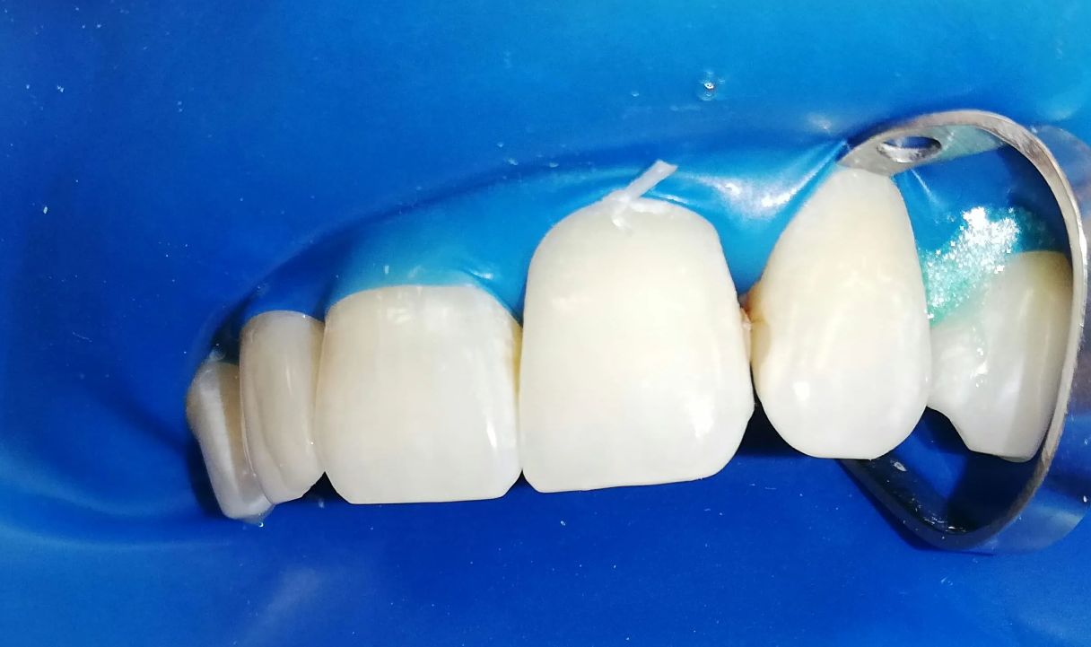 High-Quality Dental Restorations and Prosthetics